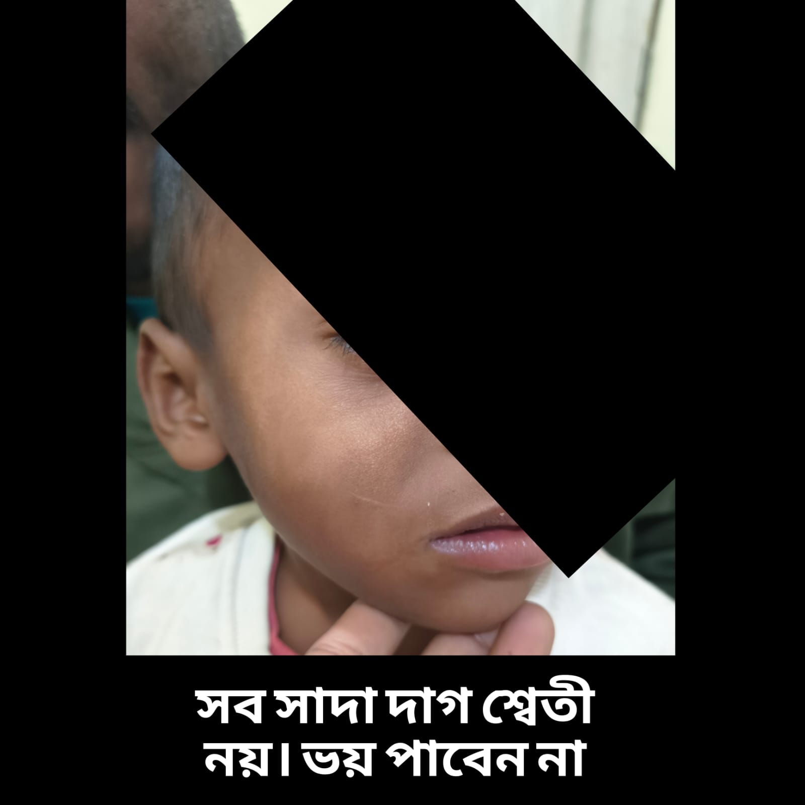 Vitiligo best doctor berhampore. 
                                                                           swati best doctor berhampore. 
                                                                           White dag treatment.
                                                                           Vitiligo treatment berhampore.