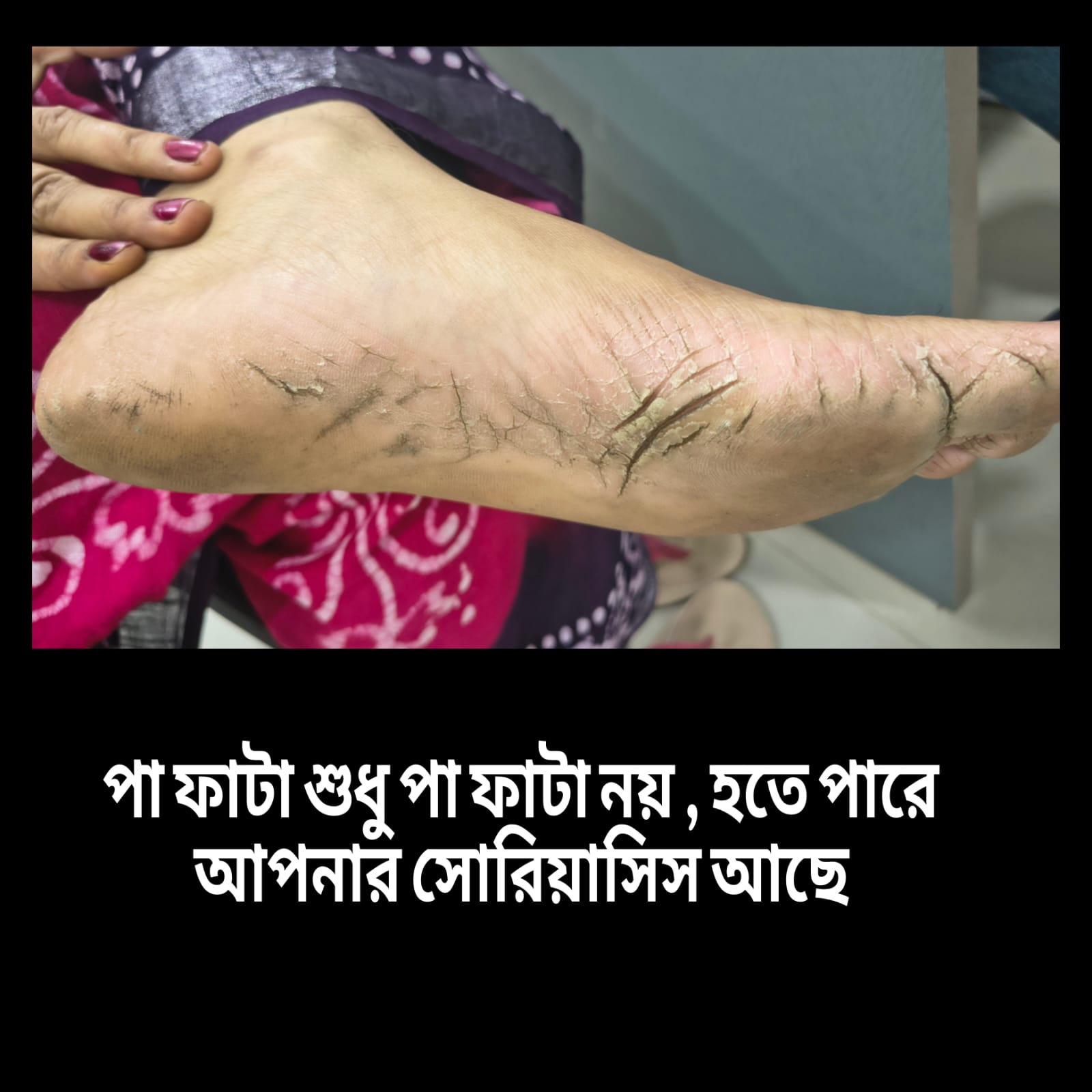 Paa fele jouya treatment berhampore. 
                                                                           Crack heel treatment berhampore.
